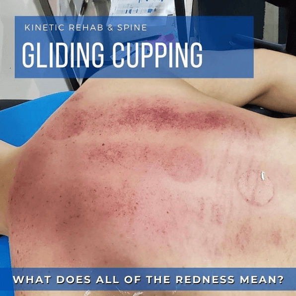 What Is Gliding Cupping Kinetic Rehab And Spine Bergen County