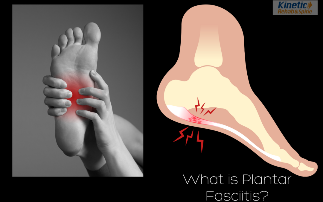 Plantar fasciitis can be a challenging condition, but with the right treatment approach, relief is possible.