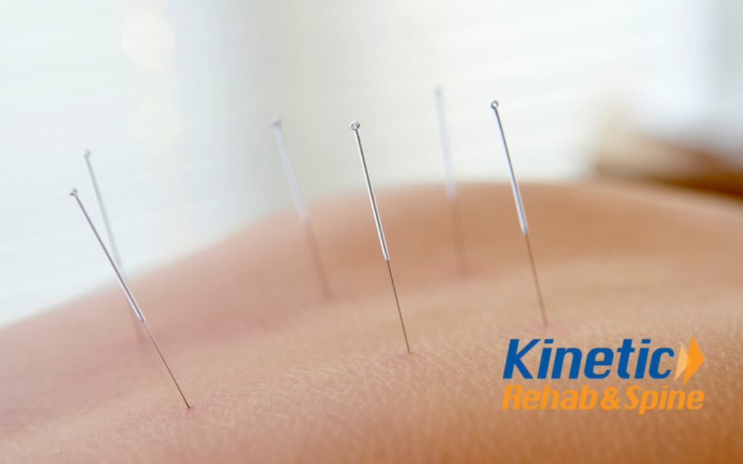 Acupuncture and Dry Needling in New Jersey | What’s the Difference?